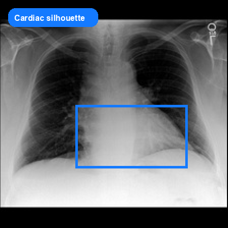 Cardiac silhouette grounded VQA sample