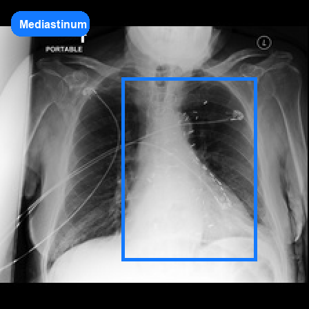 Mediastinum grounded VQA sample