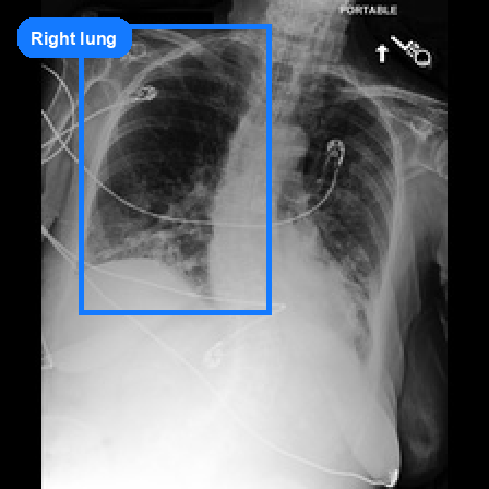 Right lung grounded VQA sample